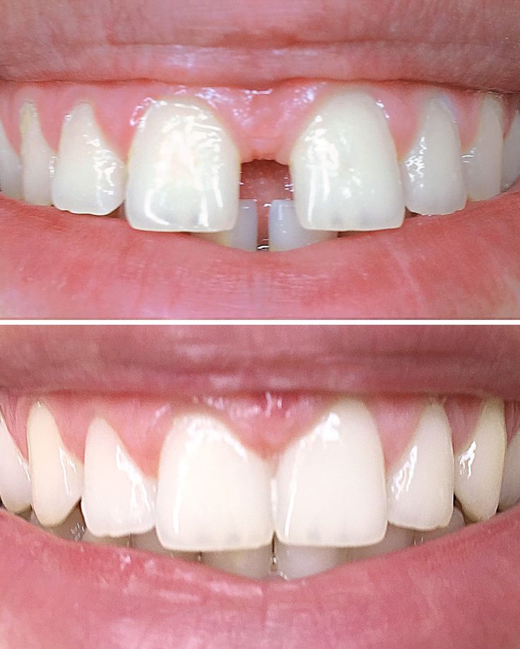 Before and after diastema (gap) closure between front teeth