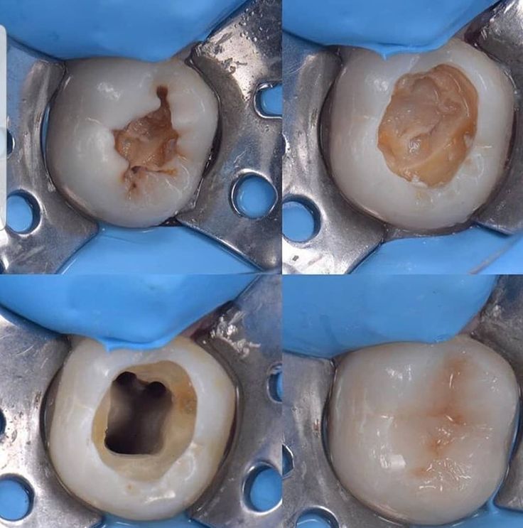 Before and after composite filling on molar - cavity removal and restoration