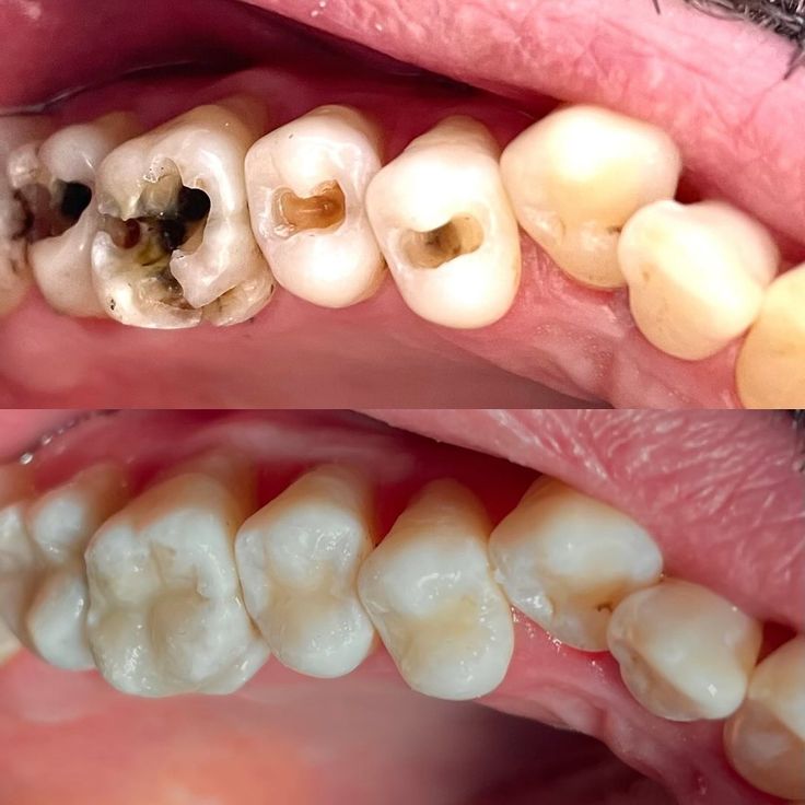 Before and after multiple decayed teeth restored with white composite fillings