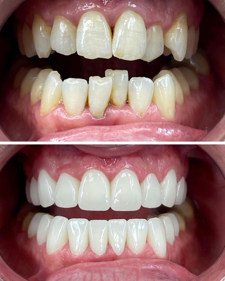 Before and after full mouth rehabilitation with crowns