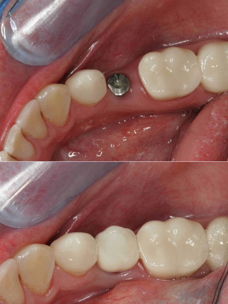 Before and after single dental implant with crown