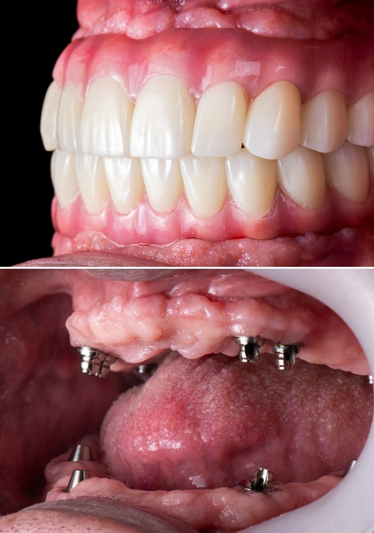 Before and after implant-supported full arch denture