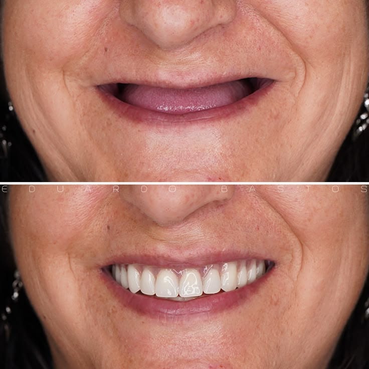 Before and after full denture fitting - complete smile restoration